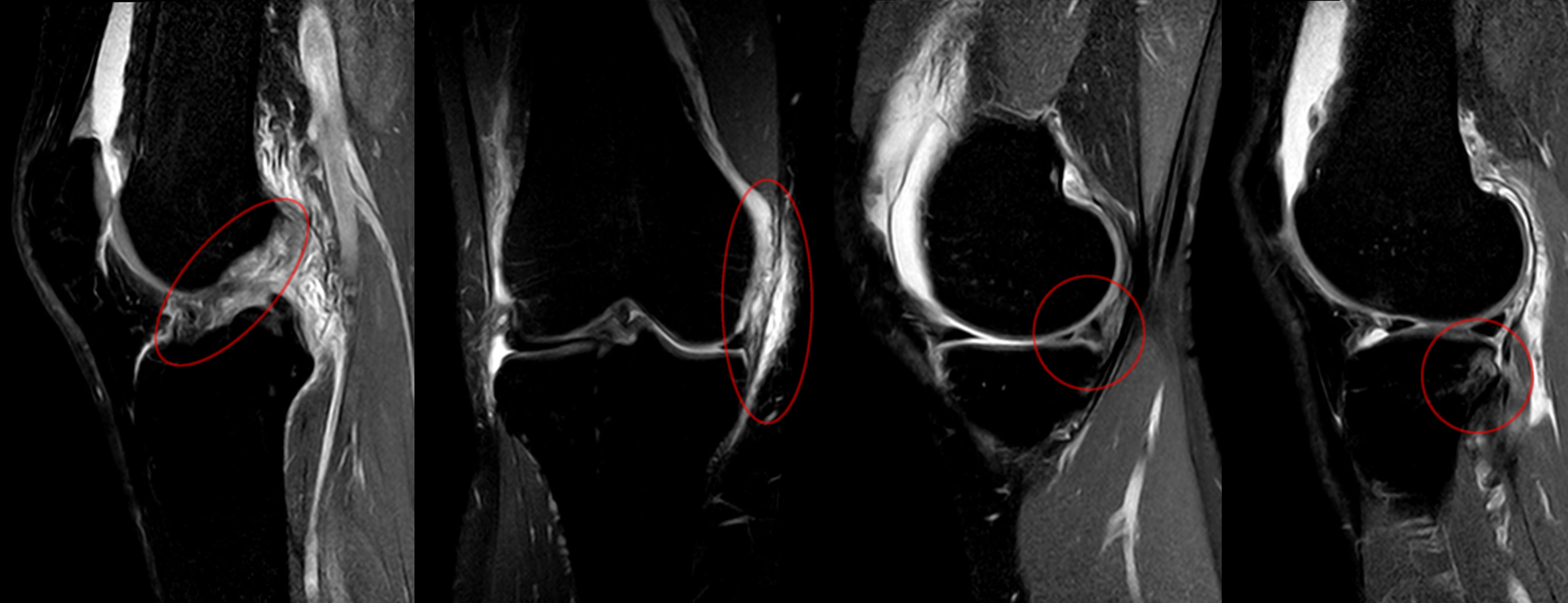 Knee MRI showing bone marrow edema