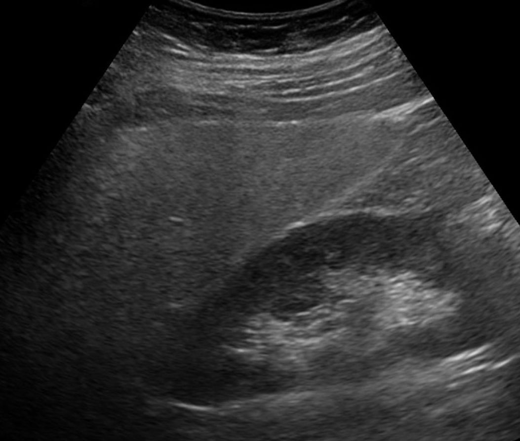 Ultrasound showing fatty liver (hepatic steatosis)