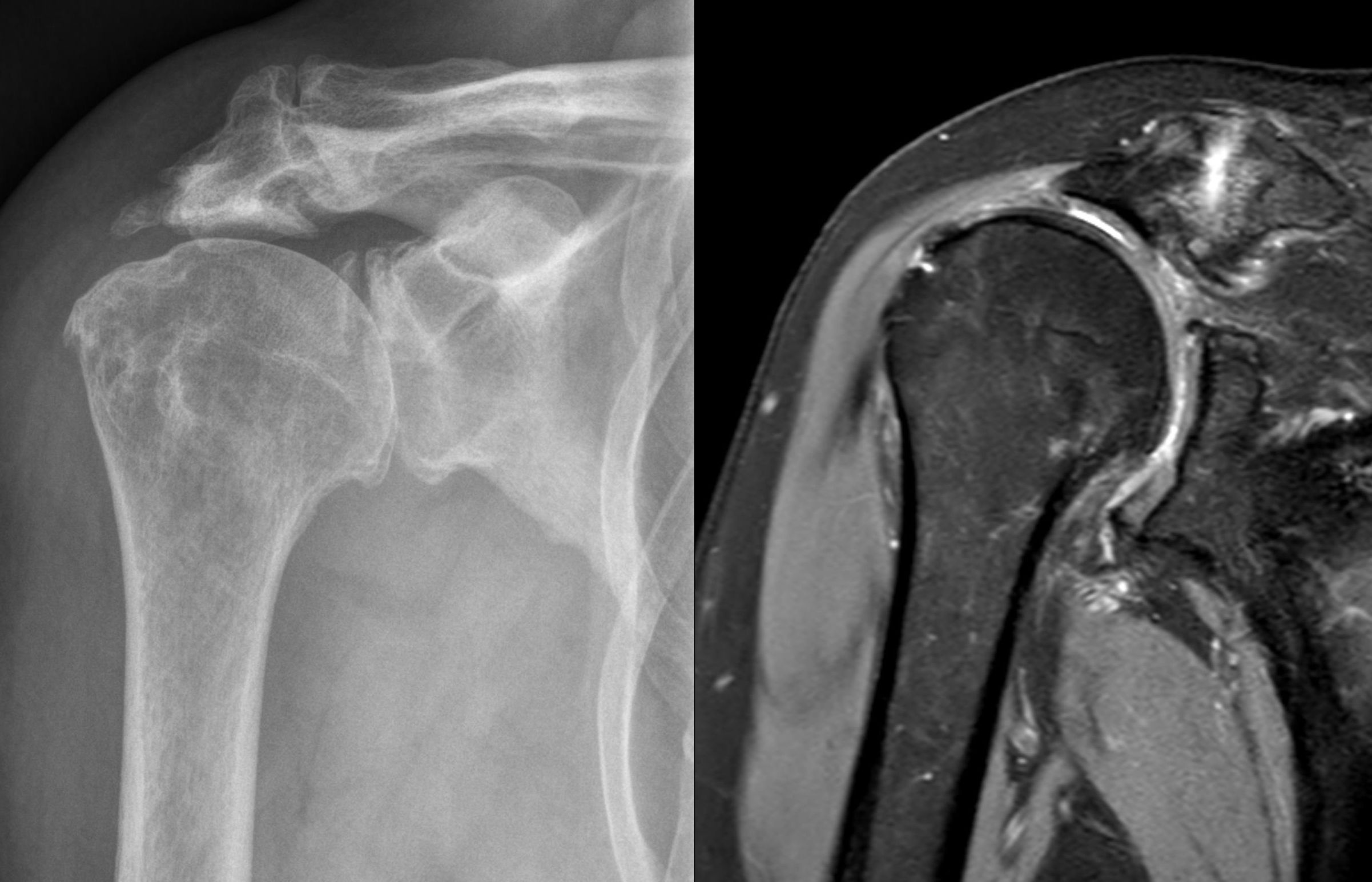 RM della spalla con patologia della cuffia dei rotatori